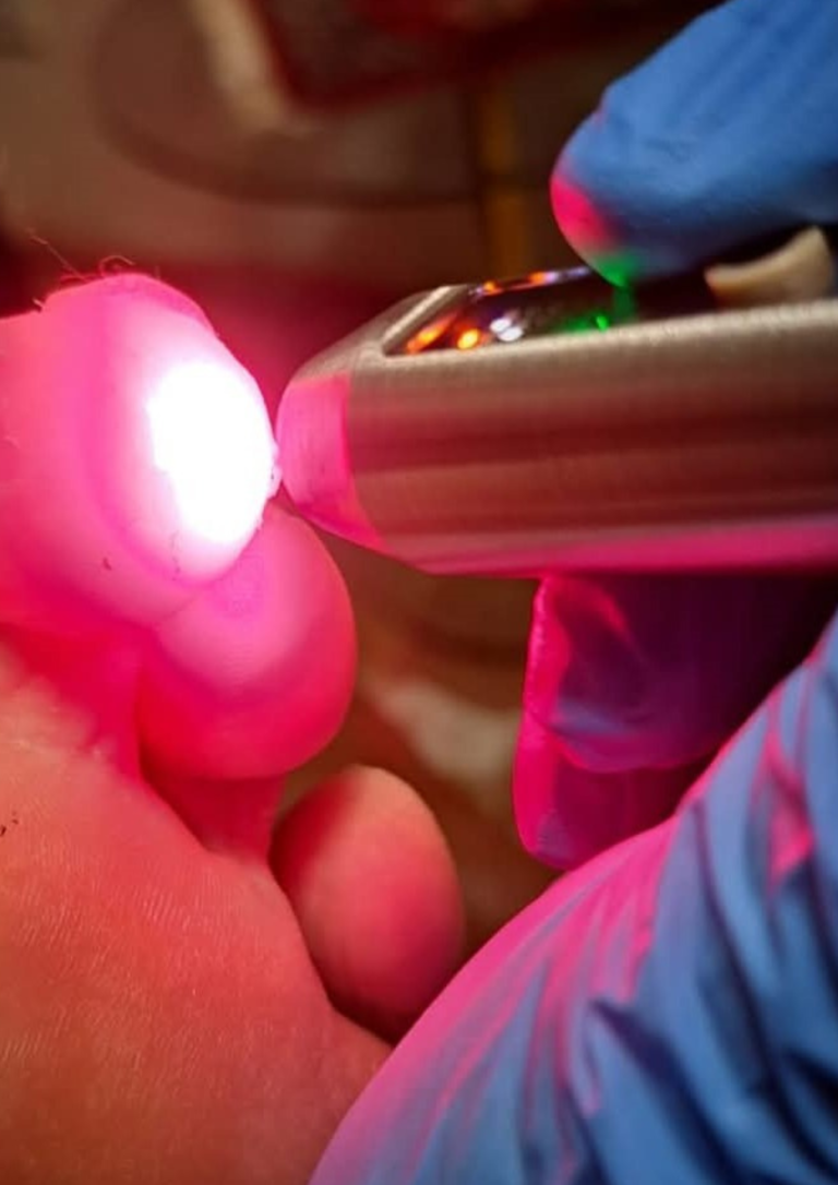 Laser Zehe 768x1086